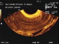 SAG Uterus (Transvaginal) Normal Early Proliferative Endometrium
