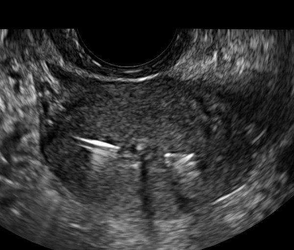 IUD Issues: Zero in with ultrasound