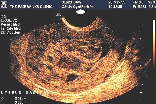 SAG Uterus (Transvaginal) Incomplete Hydatidiform Mole
