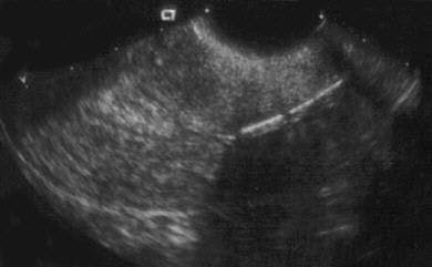 SAG Uterus IUCD Malposition (in lower UT segment)