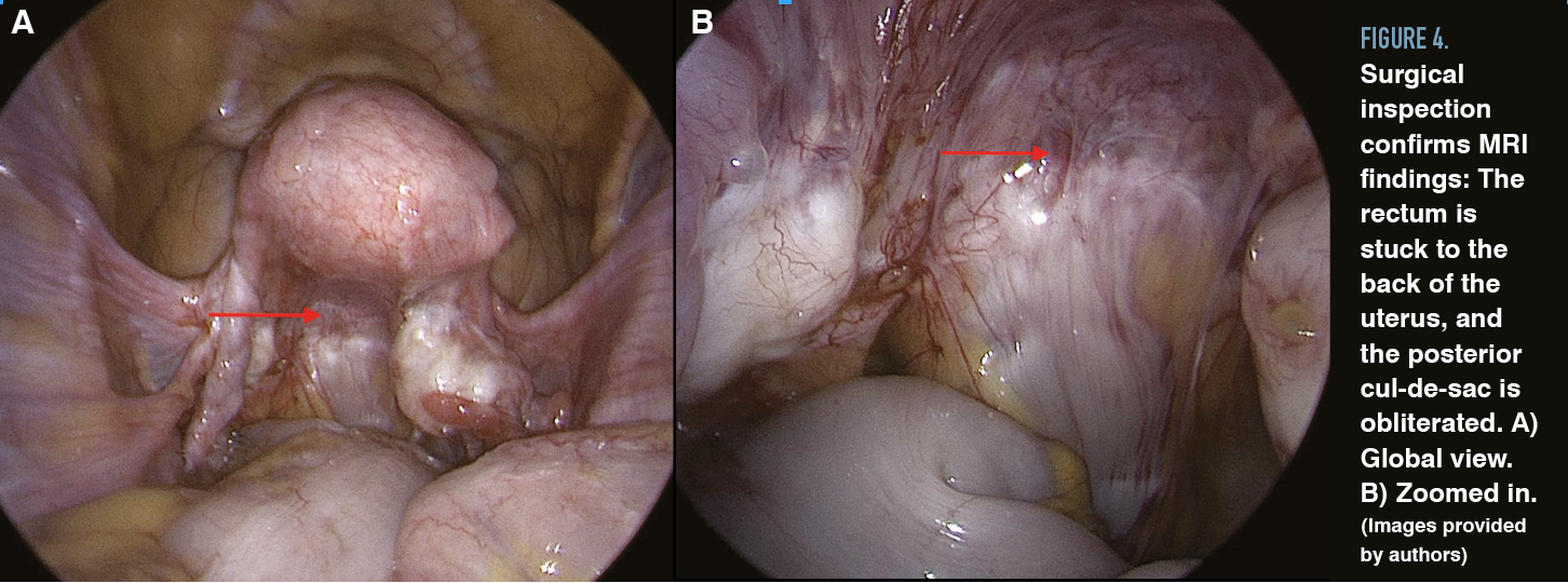 Figure 4. Surgical inspection confirms MRI findings: The rectum is stuck to the back of the uterus, and the posterior cul-de-sac is obliterated. A) Global view. B) Zoomed in. (Images provided by authors)