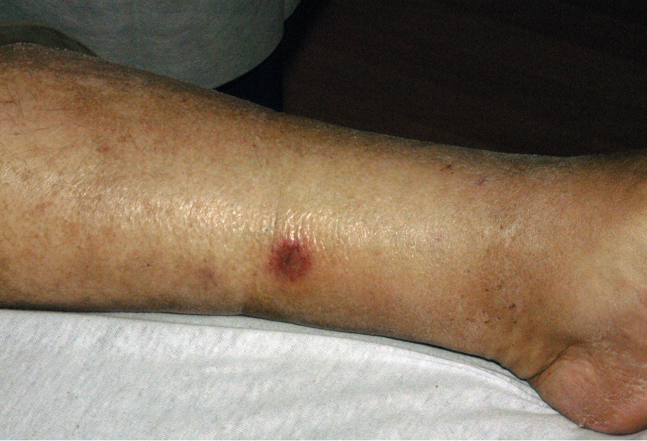 Painful erythematous lesion on the lower extremity