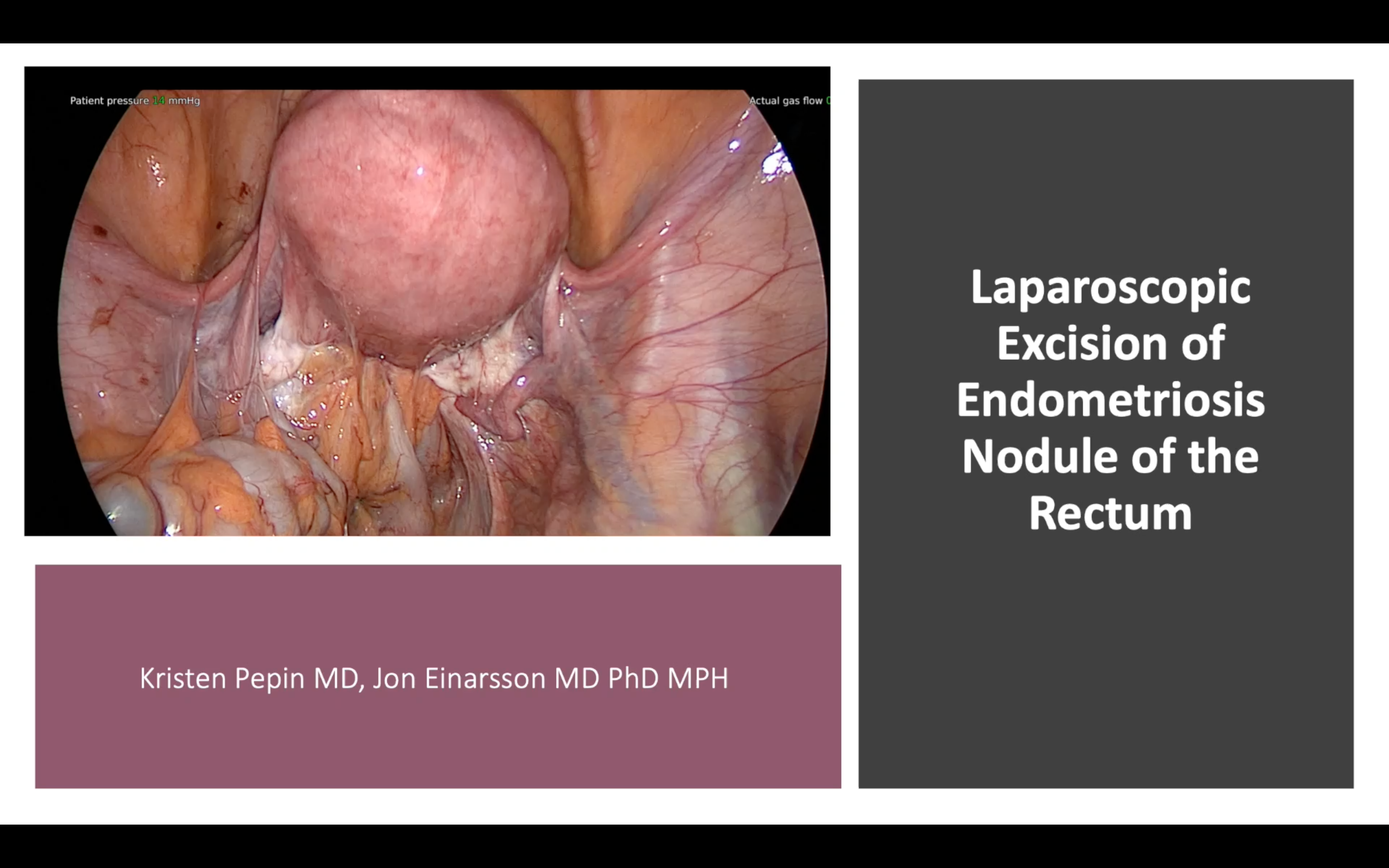 Laparoscopic excision of endometriosis nodule of the rectum