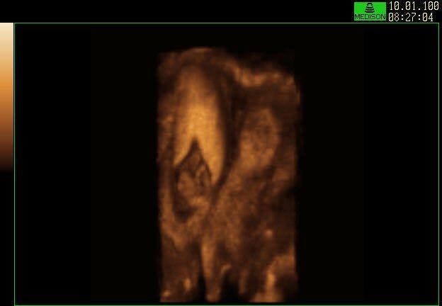 COR Uterus (3D Reconstruction) Early Pregnancy in Didephys Uterus