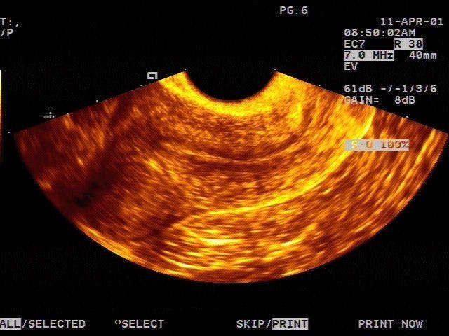 SAG Uterus Subserosal leiomyoma