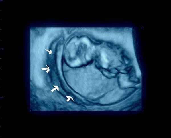 Image IQ: First-Trimester Pregnancy