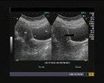 DailyDx: Diagnose this Transabdominal, Sagittal Ultrasound Image