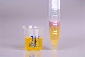 Urine Test Works for HPV Screening 