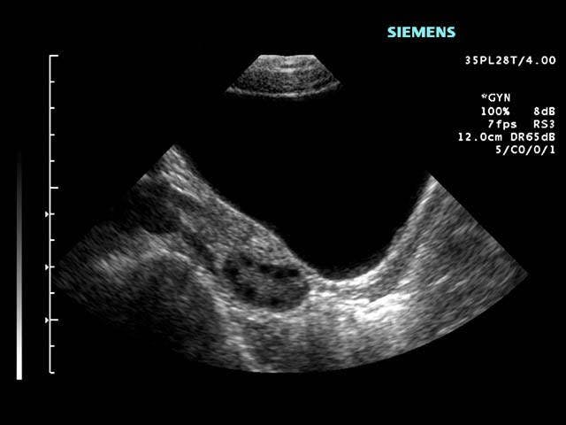 SAG Adnexa (Transabdominal) Normal Ovary