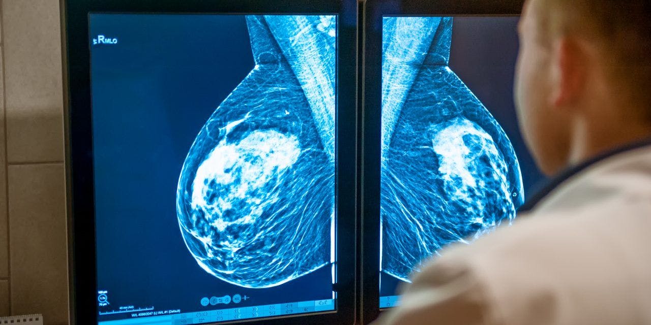 COVID-19 leads to decrease in breast cancer screenings, mammograms