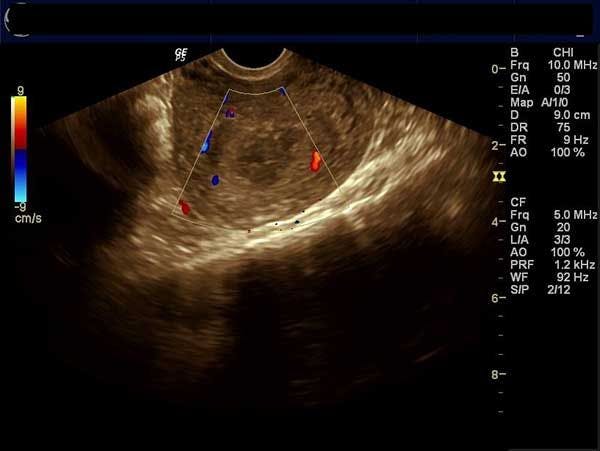 Daily Dx: Middle-aged Woman with Dysmenorrhea