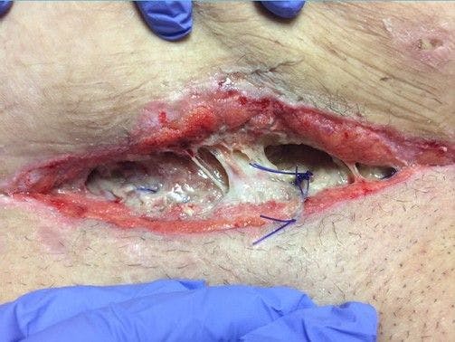 Patient incision on postoperative day 13 after repeat cesarean delivery