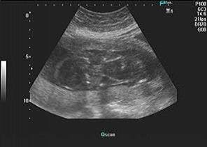 Daily Dx: A 17-week Fetus
