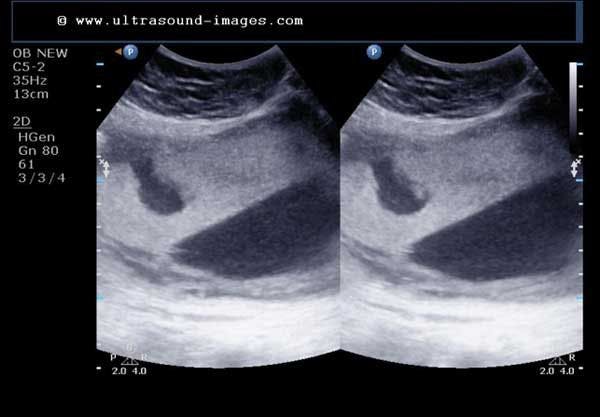 Daily Dx: Placental Lesion