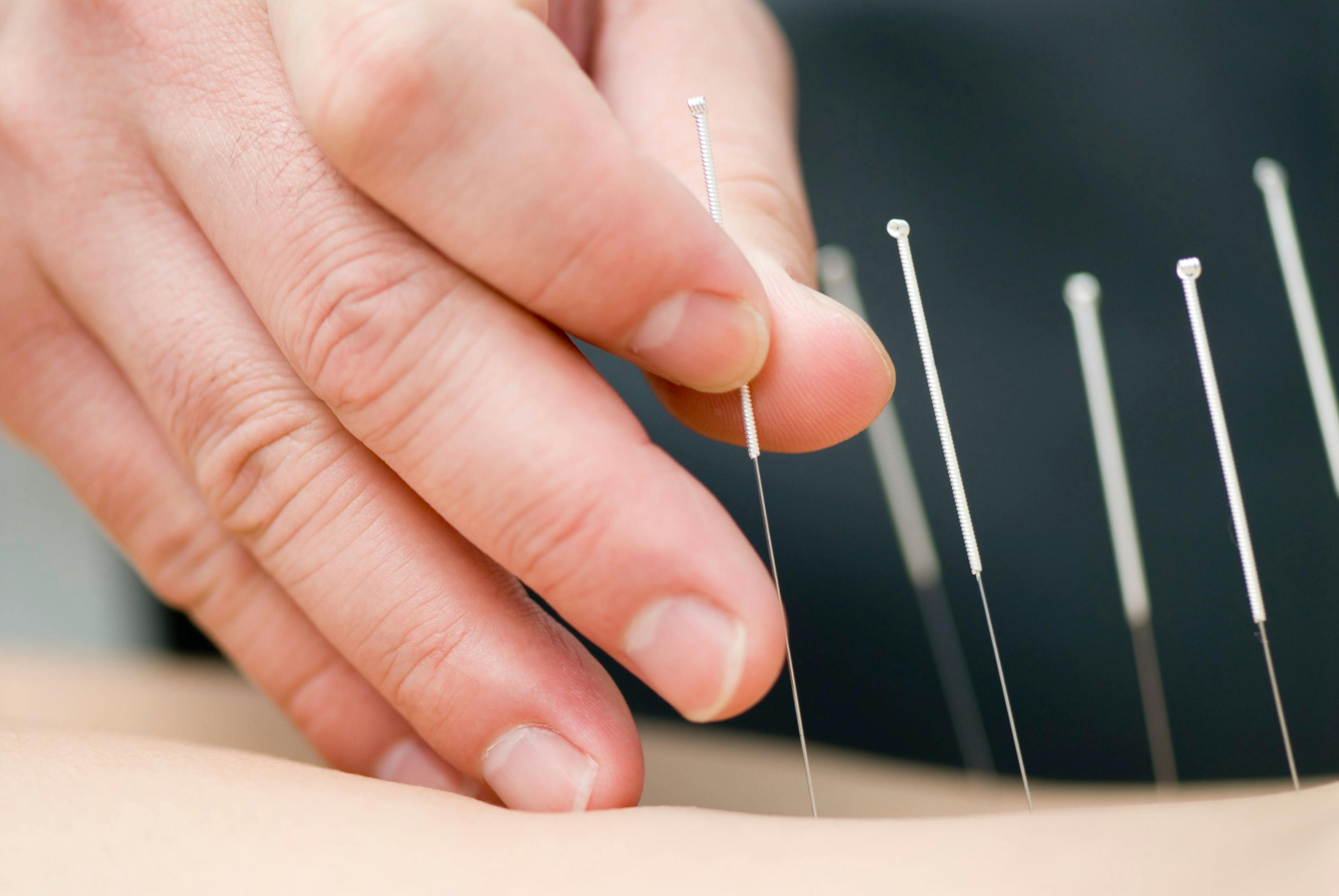 Acupuncture for pelvic floor disorders: Is it effective?