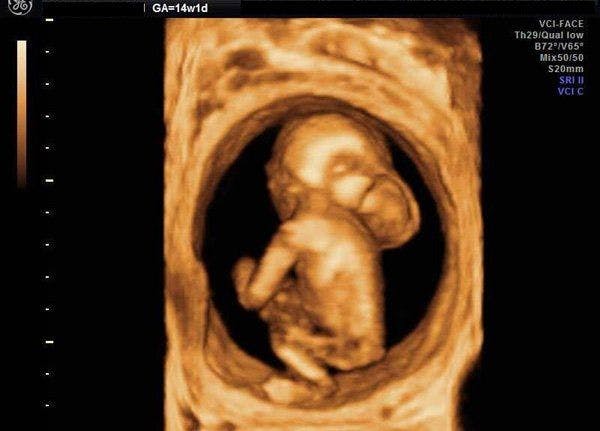 DailyDx: 3D Images of a 14-week fetus