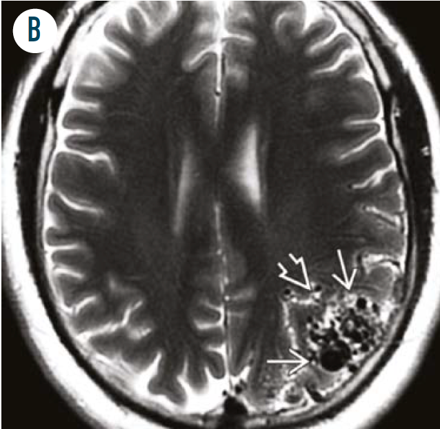 Figure 2B. Axial T2WI MR in the same patient shows a triangular wedge-shaped collection of flow voids . The broad base of the wedge is at the cortical surface, whereas the apex of the triangle extends into the deep sulci and subcortical white matter, pointing towards the lateral ventricle. (Figure reprinted with permission from Elsevier/StatDx)