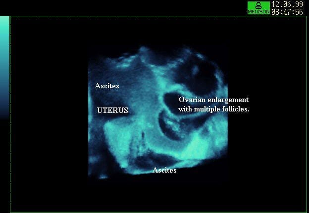 3D Reconstruction, Uterus, Adnexa Ovarian Hyperstimulation, Ascites