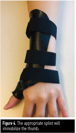 Figure 4. The appropriate splint will immobilize the thumb.