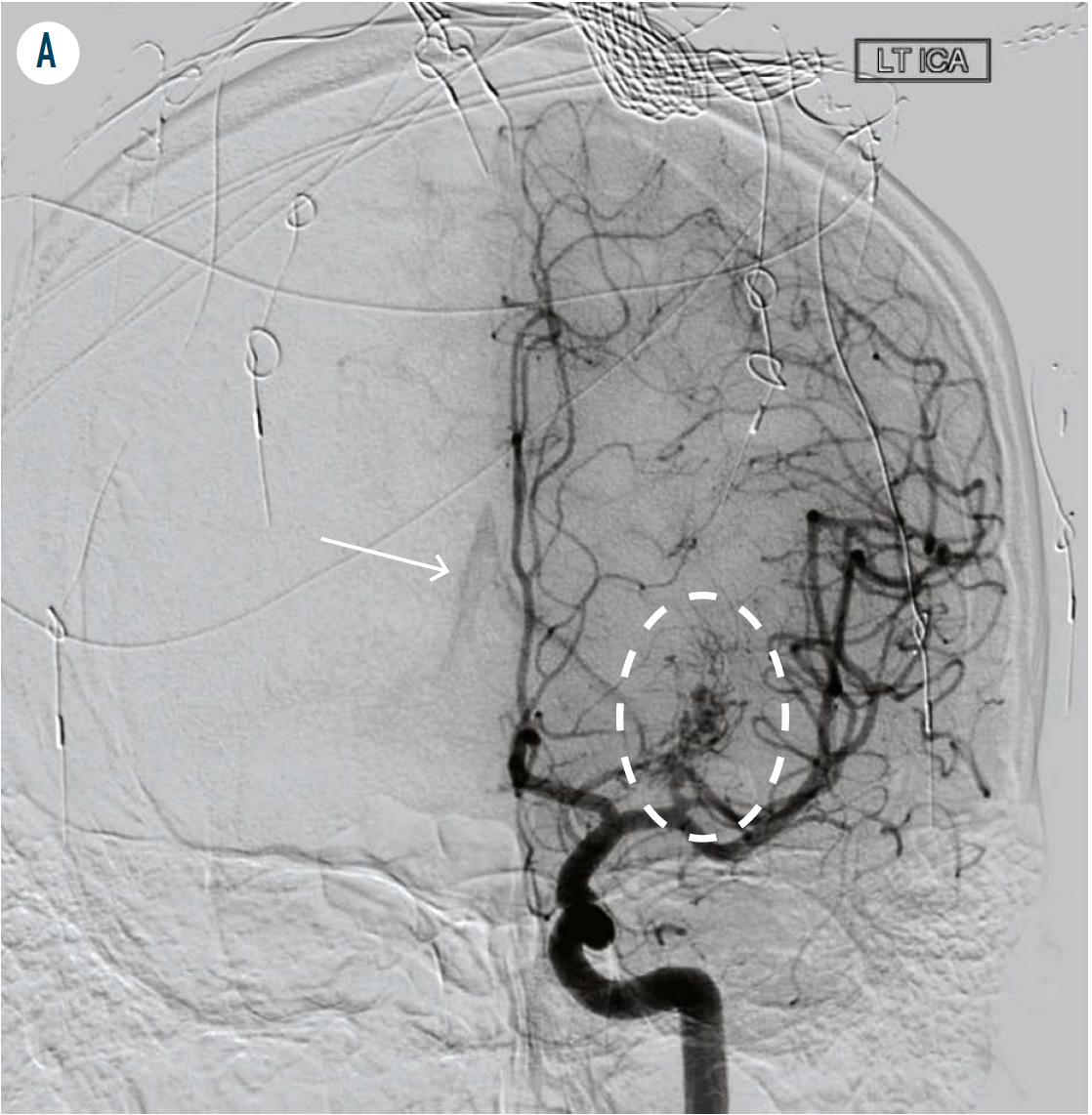 FIGURE 4A. Initial cerebral catheter angiogram shows a small left thalamic AVM (dashed oval). Notice the early draining vein (white arrow) in the center of the image–a characteristic AVM feature–an early drainage from the AVM nidus, which appears to cross midline. (Figure author provided)