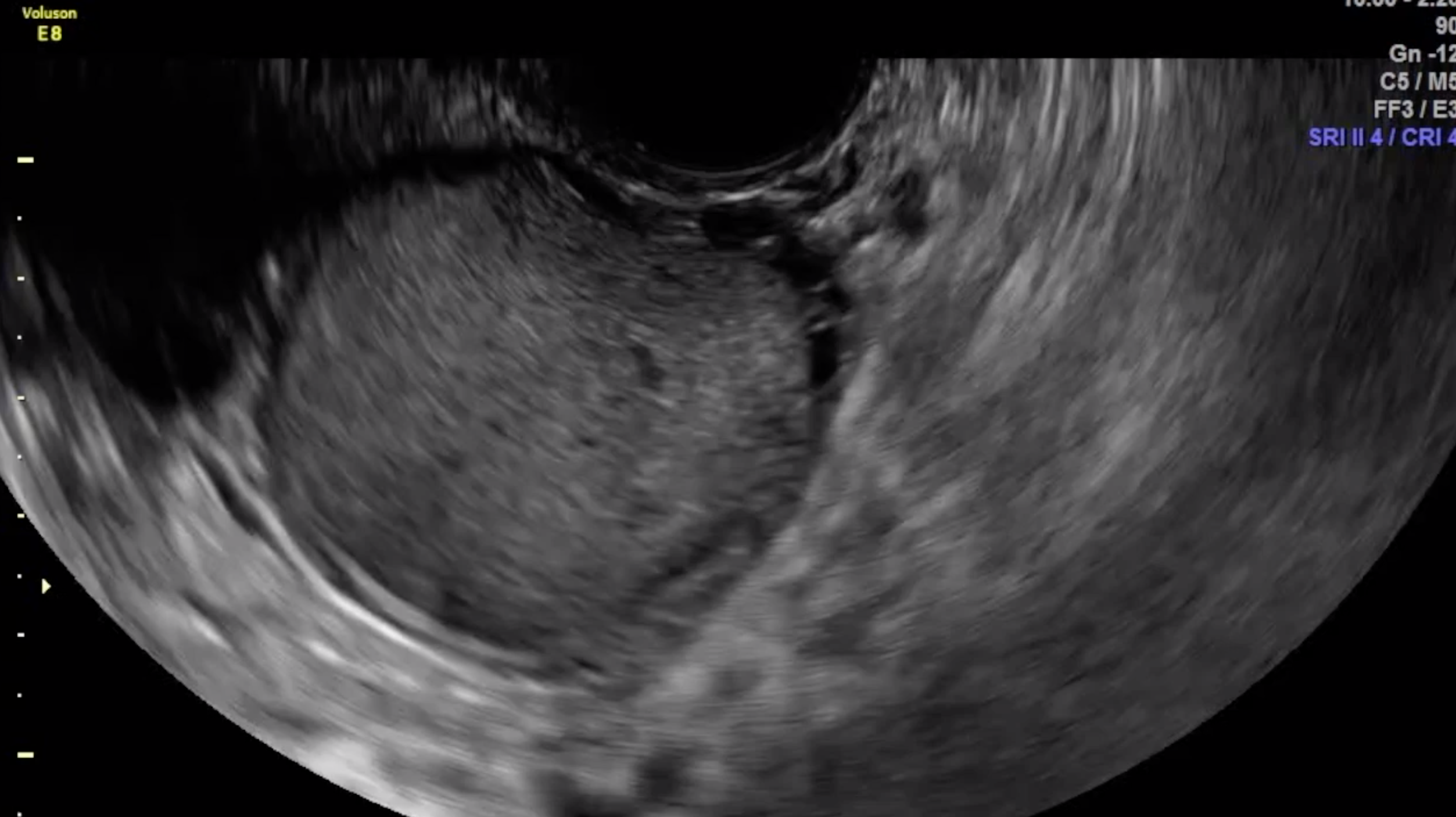 Ovarian endometrioma within laterally mobile ovary