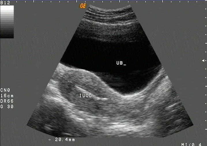 SAG Intrauterine contraceptive device inside endometrial cavity 2D ultrasound