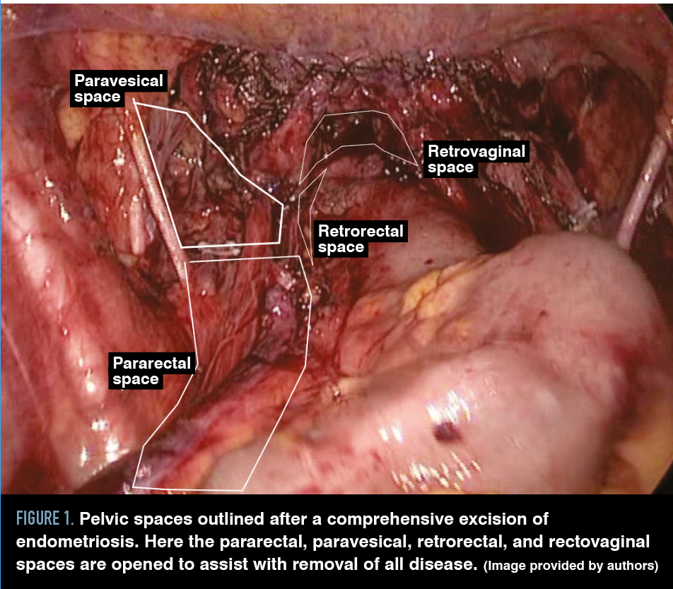 Figure 1. Pelvic spaces outlined after a comprehensive excision of endometriosis. Here the pararectal, paravesical, retrorectal, and rectovaginal spaces are opened to assist with removal of all disease. (Image provided by authors)