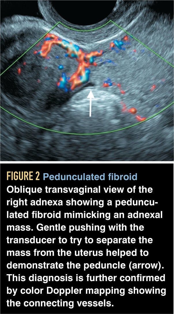 Pedunculated fibroid
