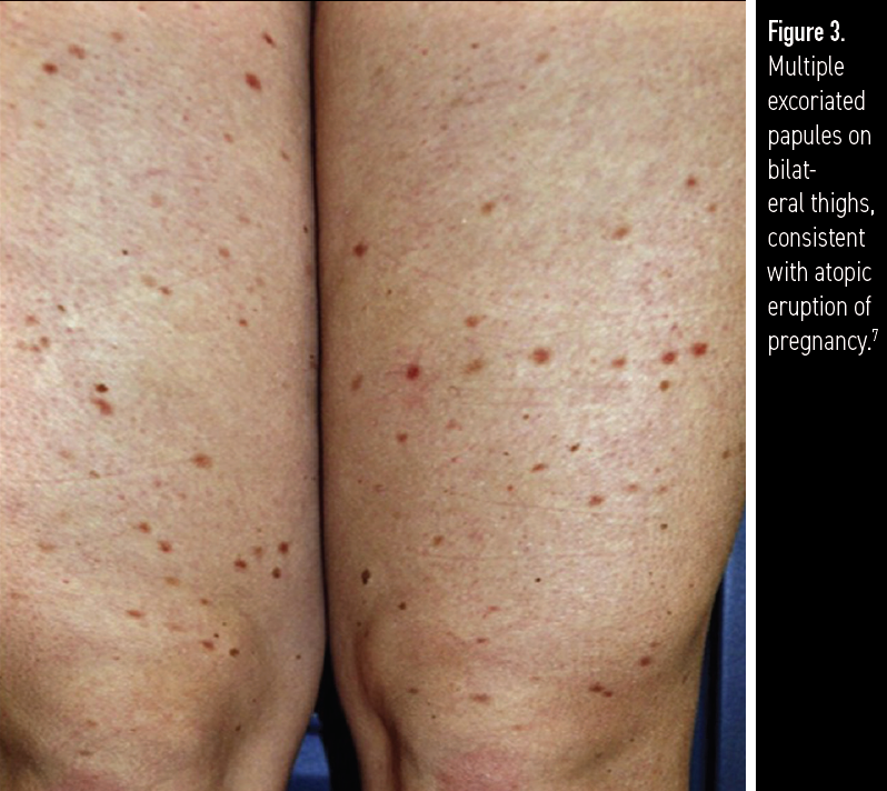 Figure 3. Multiple excoriated papules on bilateral thighs, consistent with atopic eruption of pregnancy.7