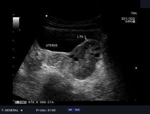 Daily Dx: Pelvic Pain in Young Girl