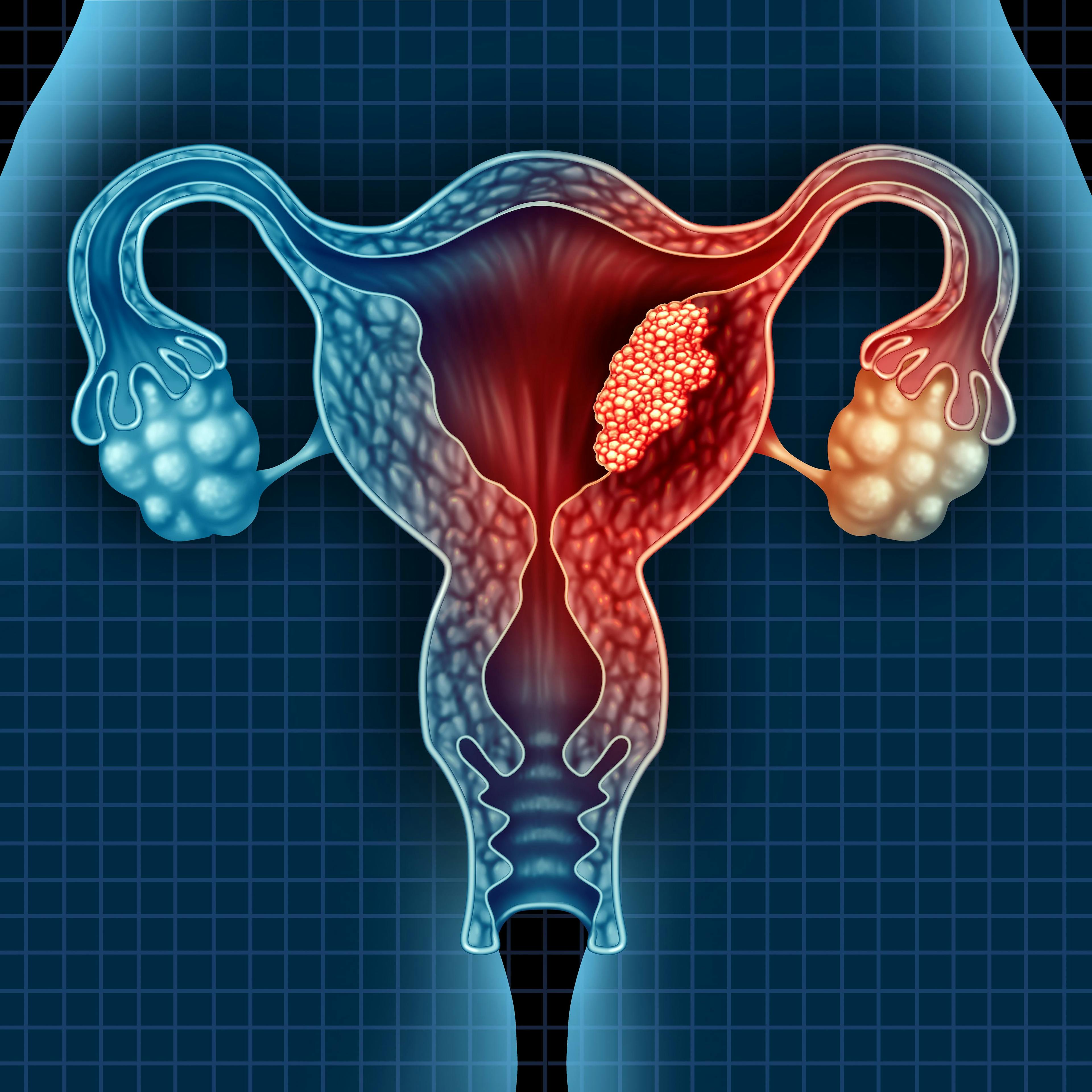 Retifanlimab shows promising antitumor activity in advanced endometrial cancer