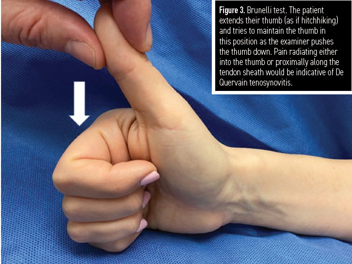 Figure 3. Brunelli test. The patient extends their thumb (as if hitchhiking) and tries to maintain the thumb in this position as the examiner pushes the thumb down. Pain radiating either into the thumb or proximally along the tendon sheath would be indicative of De Quervain tenosynovitis.