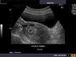 DailyDx: What is the Diagnosis of this Uterus?