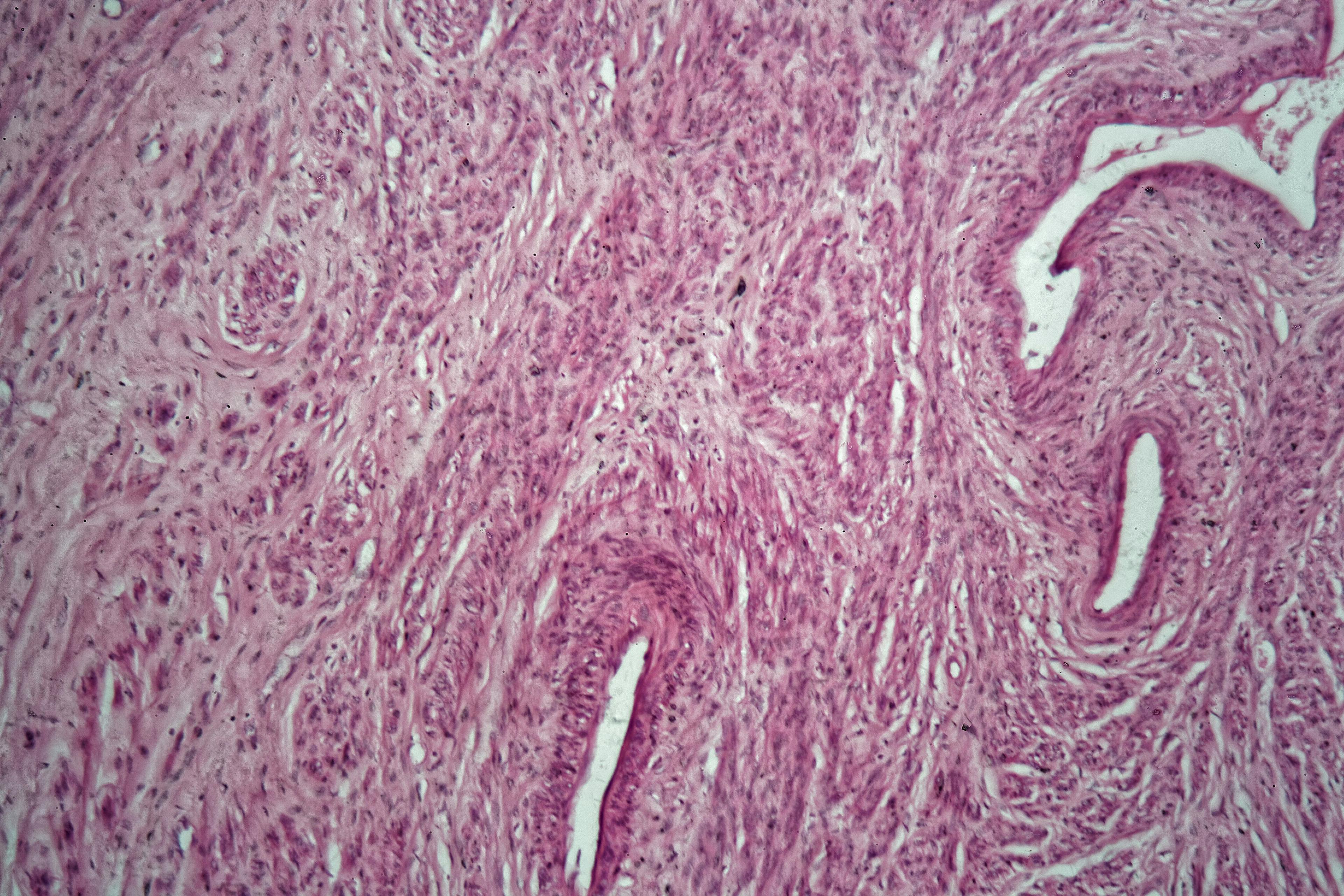 Cells of a human uterus with uterine fibroids under the microscope.