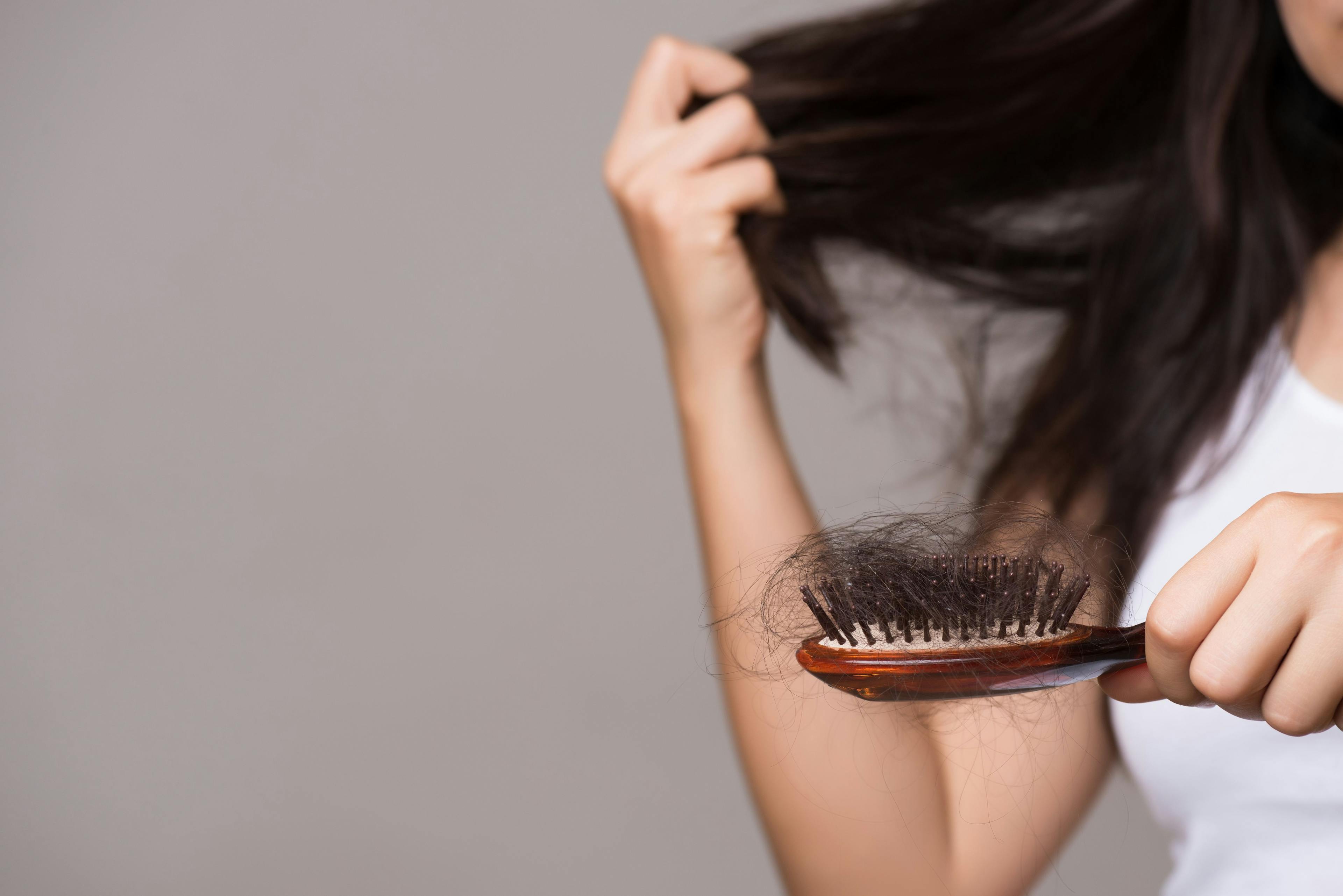 Discomfort over hair thinning prevalent in women | Image Credit: © Siam - © Siam - stock.adobe.com.