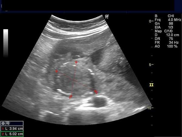 Daily Dx: An Early Third-Trimester Pregnancy