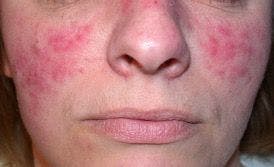 Rosacea: disagnosis and treatments for women, and best interventions for pregnant patients