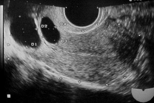 SAG Uterus (Transvaginal) Nabothian Cysts