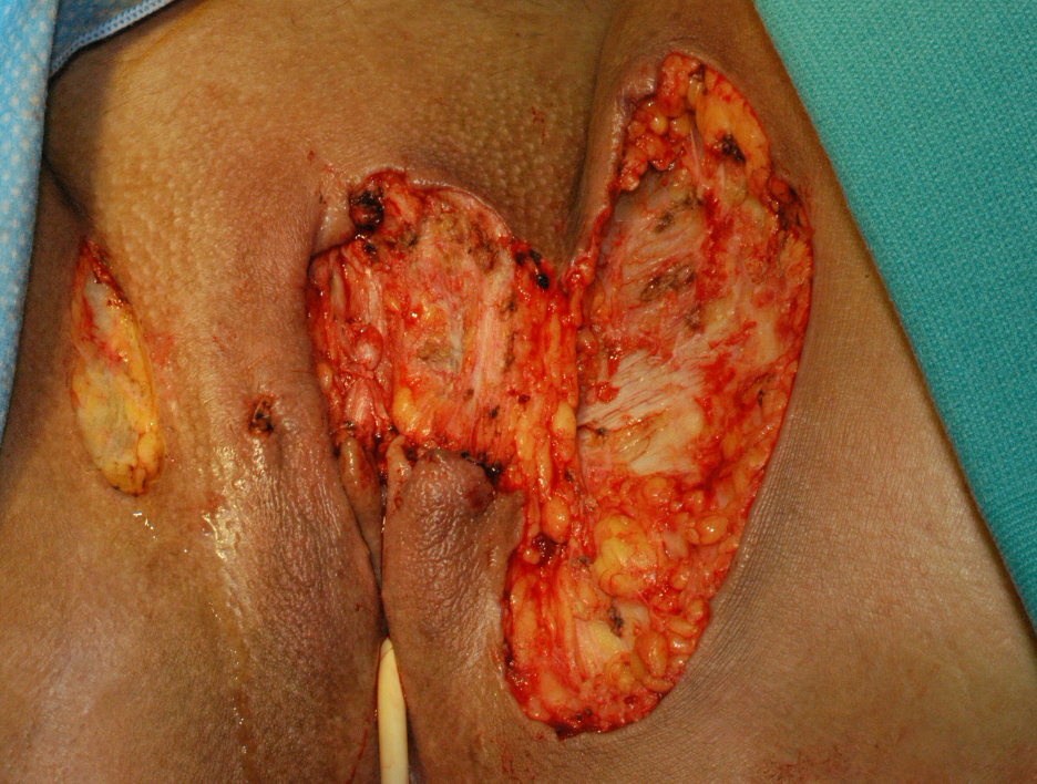 Partial vulvectomy with excision of multiple areas, including portions of the labia majora, labia minora, clitoris, and inner thighs