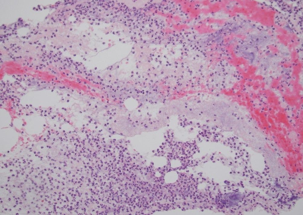 Histopathology from abscess biopsy confirming abscess formation with fibrin deposits and overwhelming neutrophilic response