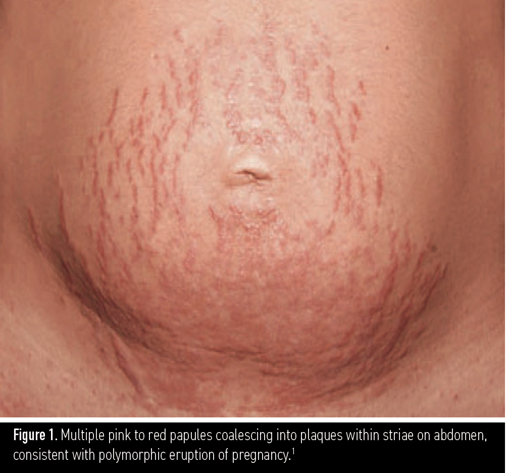 Figure 1. Multiple pink to red papules coalescing into plaques within striae on abdomen, consistent with polymorphic eruption of pregnancy.1