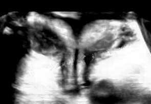 Daily Dx: Unusual Findings on a Pelvic Sonography 