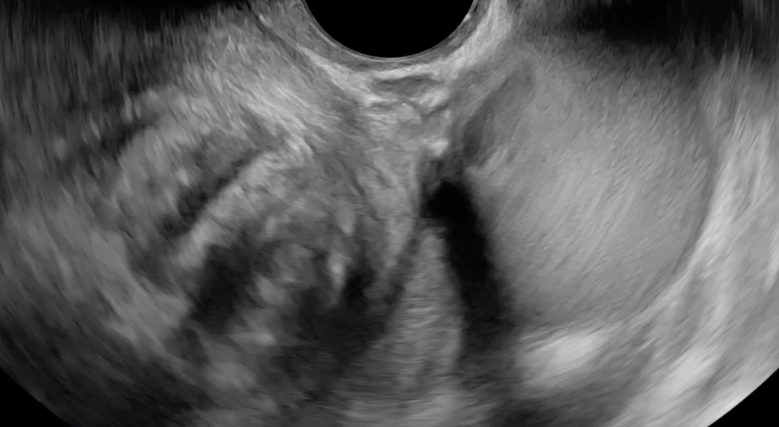 Ovarian endometrioma within inferomedially immobile ovary.