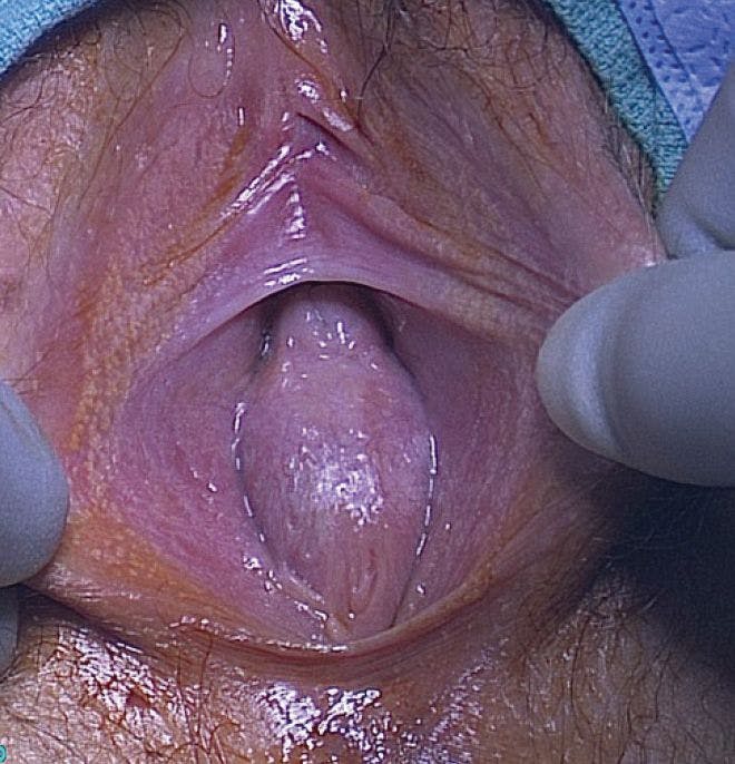 Figure 4. Imperforate hymen