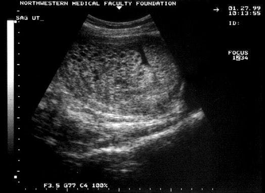 Ultrasounds - Hydatidiform mole