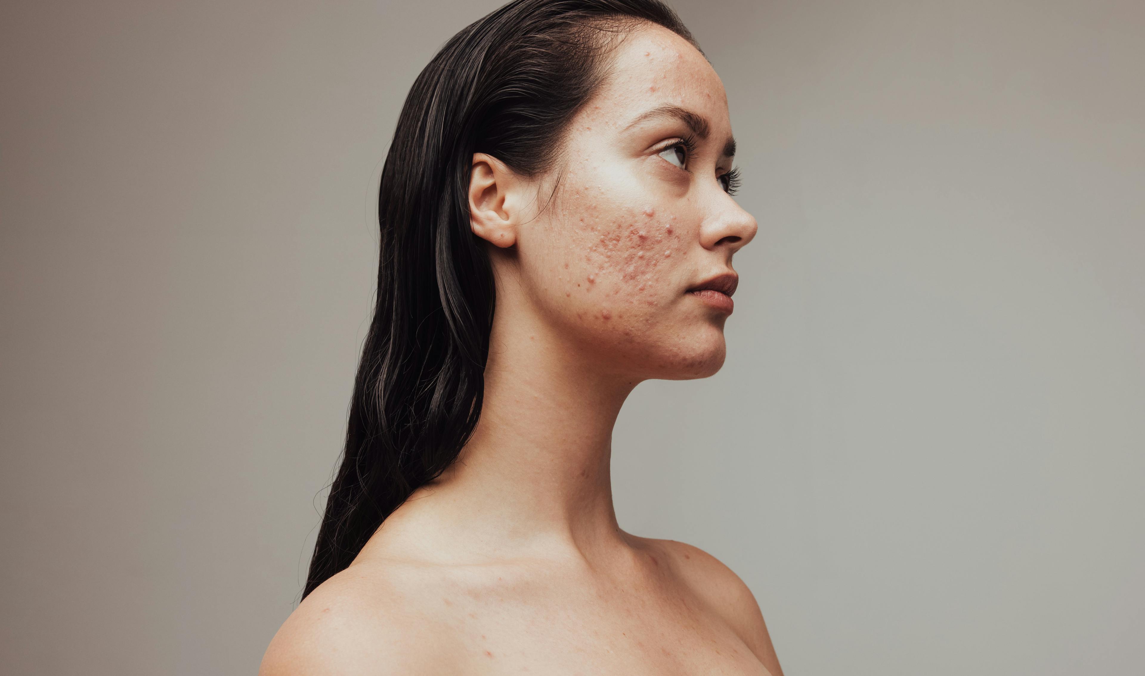 Spironolactone found to be effective alternative to oral antibiotics for women with acne | Image Credit: © Jacob Lund - © Jacob Lund - stock.adobe.com.
