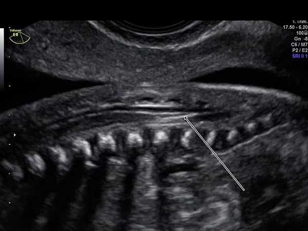 Image IQ: Anatomy of the Fetal Spine