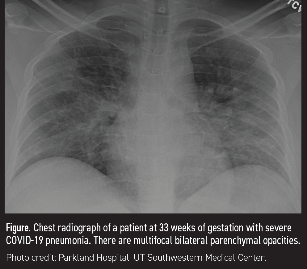Figure. Chest radiograph of a patient at 33 weeks of gestation with severe COVID-19 pneumonia. There are multifocal bilateral parenchymal opacities.

Photo credit: Parkland Hospital, UT Southwestern Medical Center.