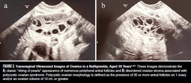 Transvaginal Ultrasound Images of Ovaries in a Nulligravida, Aged 30 Years