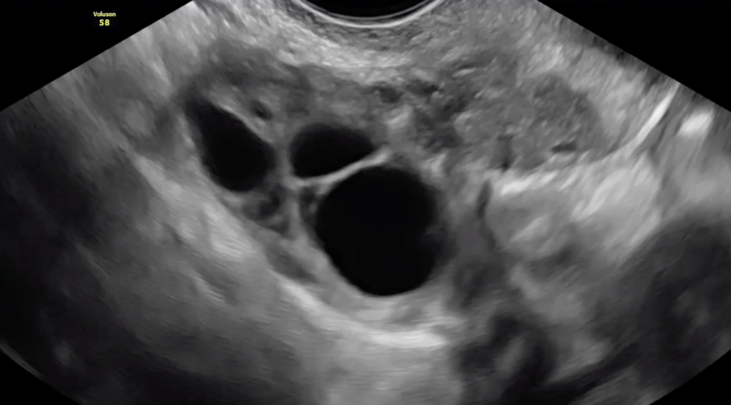 Normal ovary with circumferential mobility.
